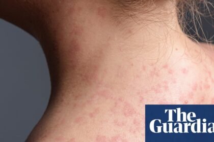 California warns of measles exposure in six counties from unvaccinated train passenger