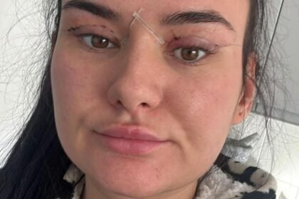 Open wounds and eyes that can't close - women warn about cheap bleph eyelid surgery