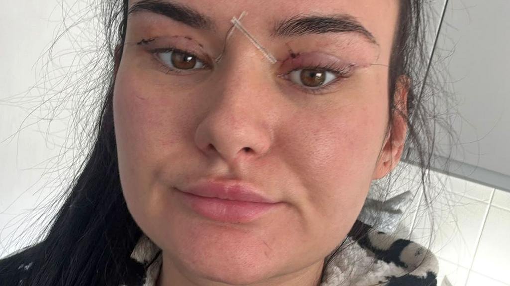 Open wounds and eyes that can't close - women warn about cheap bleph eyelid surgery