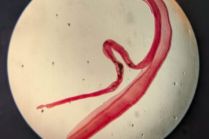 Woman's brain worm infection confirmed after eggs grow tails in lab test