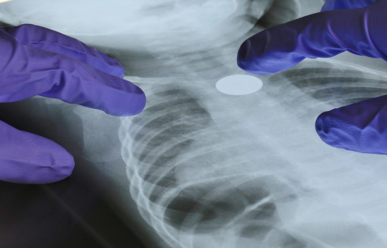 A Genetic Mutation May Help Explain Lung Cancer in Nonsmokers