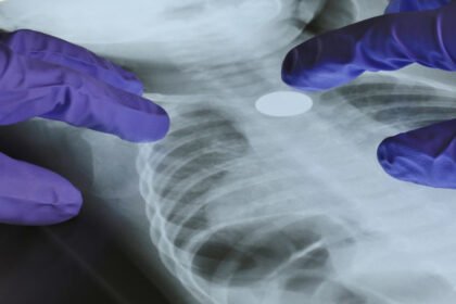 A Genetic Mutation May Help Explain Lung Cancer in Nonsmokers