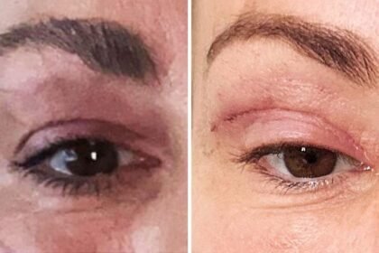 'My eyelids became infected - I was scared to sleep'