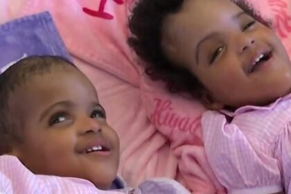 Conjoined toddlers see each other face-to-face for the first time