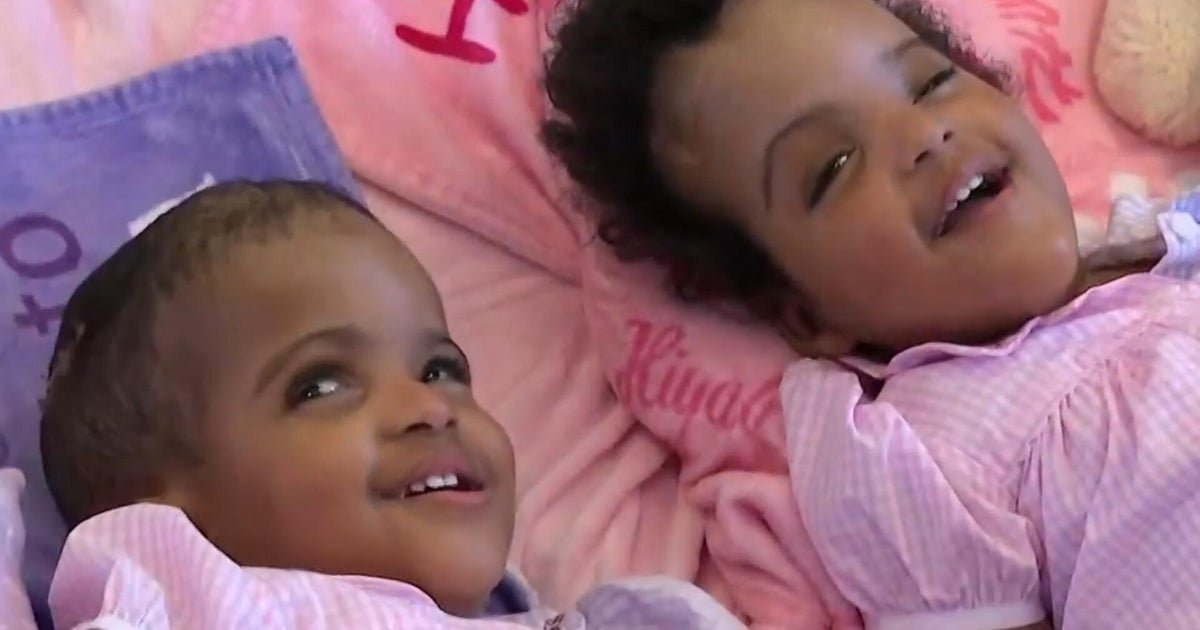 Conjoined toddlers see each other face-to-face for the first time