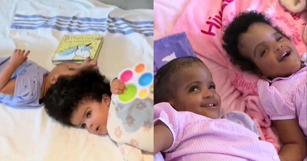 Twins conjoined at the head are separated in 25-hour surgery
