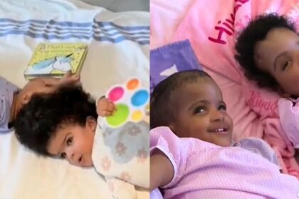 Doctors successfully separate twin girls conjoined at the head