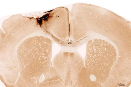 Stem cells reverse stroke damage and restore movement in mice