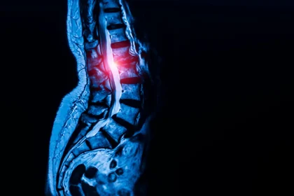 Hidden stem cells may be fueling spinal stenosis