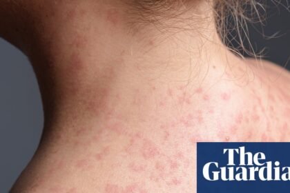 Pennsylvania faces largest measles outbreak in decades as case count rises to 1,000