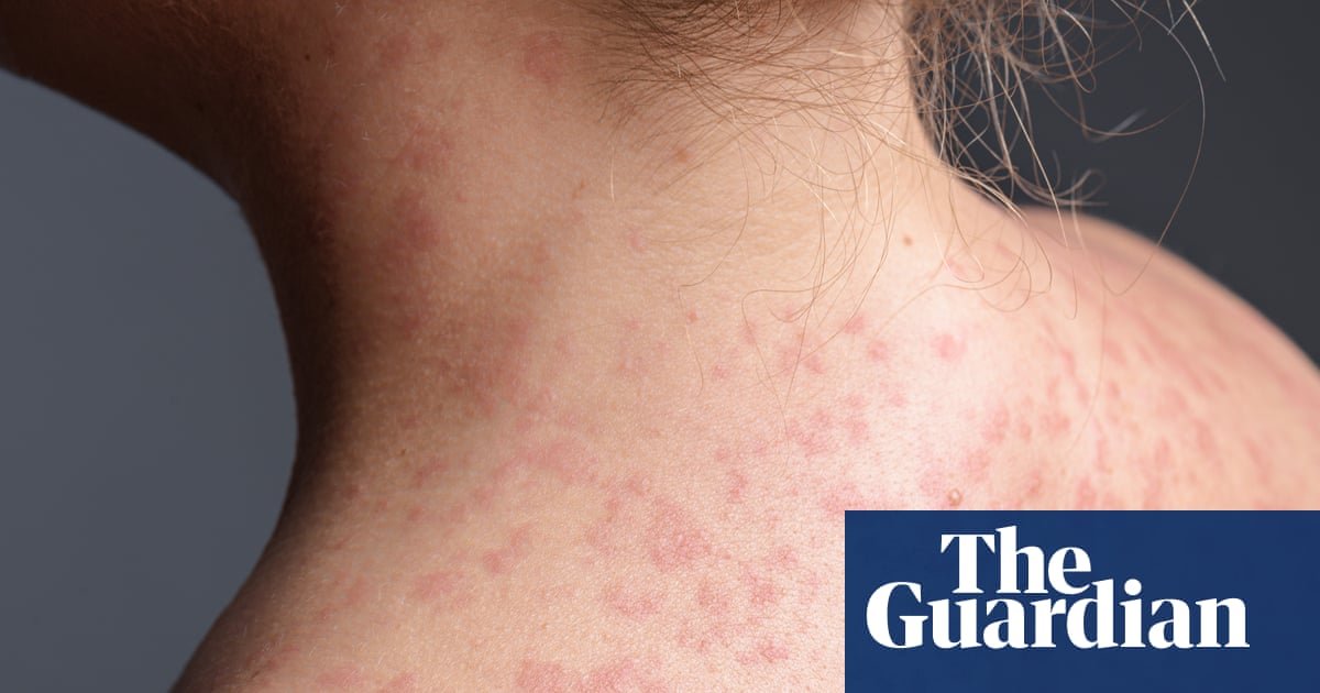Pennsylvania faces largest measles outbreak in decades as case count rises to 1,000