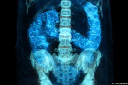 Early-onset cancer rising worldwide: Causes, risk, prevention