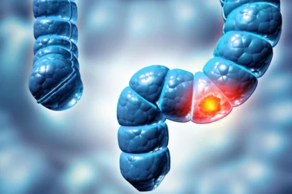 Colorectal cancer is rising in young people and often found too late