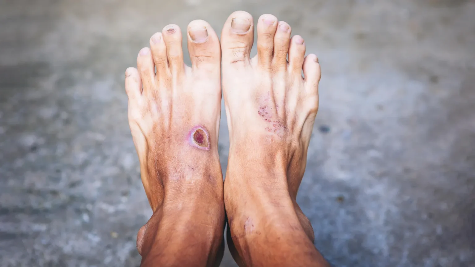 Scientists may have found why diabetic wounds refuse to heal