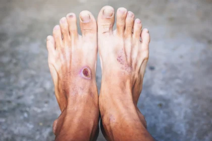 Scientists may have found why diabetic wounds refuse to heal