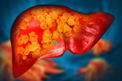 A plastic once thought harmless may be fueling fatty liver disease