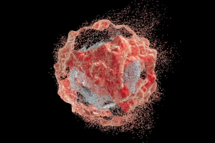 Bowel cancer “melted away” after immunotherapy, then stayed away